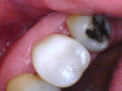 After Biomimetic and Bioclear Method