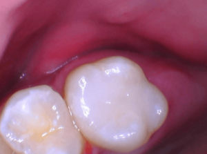 After Diastema Closure